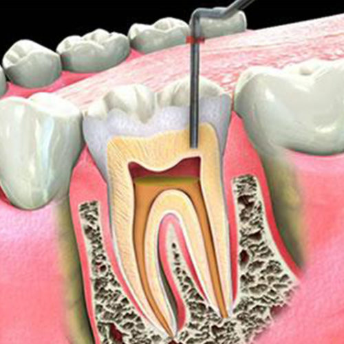 Kanal Tedavisi / Endodonti