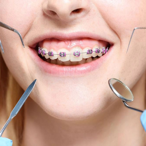 Ortodonti / Diş Teli Tedavisi